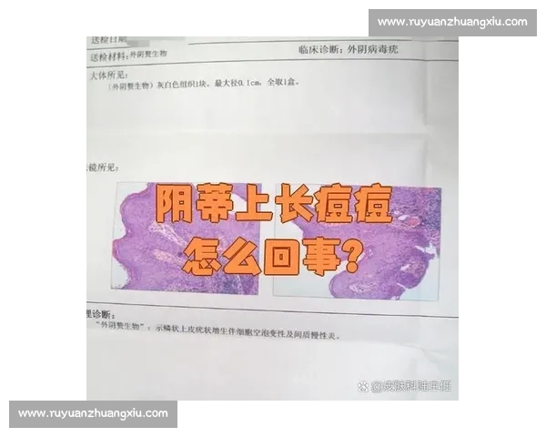 尖锐湿疣的早期症状与治疗方法探讨及预防措施分析